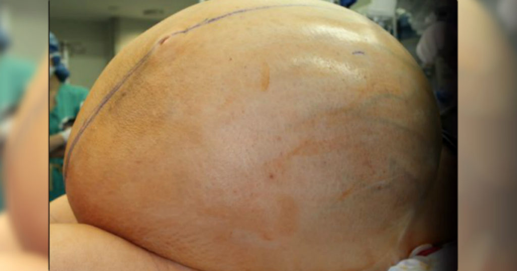 132 Pound Tumor Has Woman Desperate As Doctors Race To Remove It 