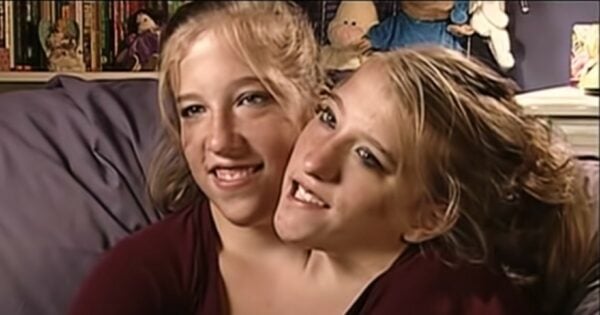 conjoined twins abby and brittany