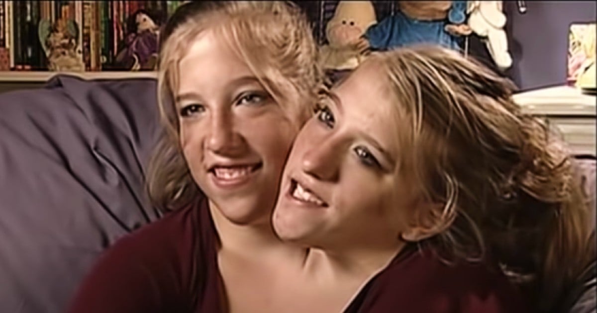 Abby and brittany hensel where are they now xaservoip