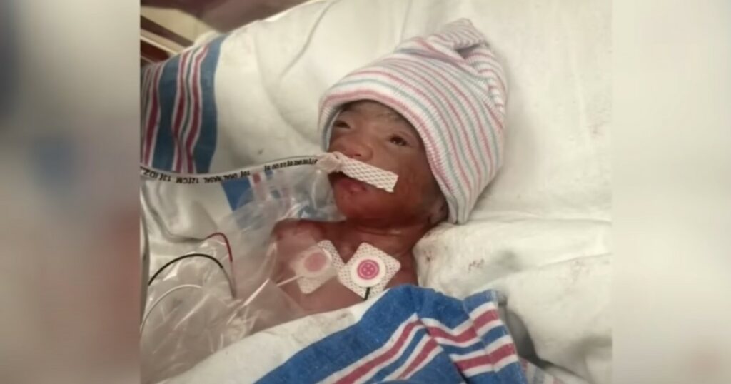 Premature Baby Weighing 1 Pound, Greyson Butler, Goes Home